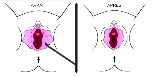 CHIRUGIE INTIME DE LA VULVE 1