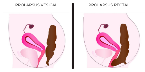 DESCENTE D'ORGANES PROLAPSUS