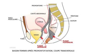 DESCENTE D'ORGANES PROLAPSUS 1