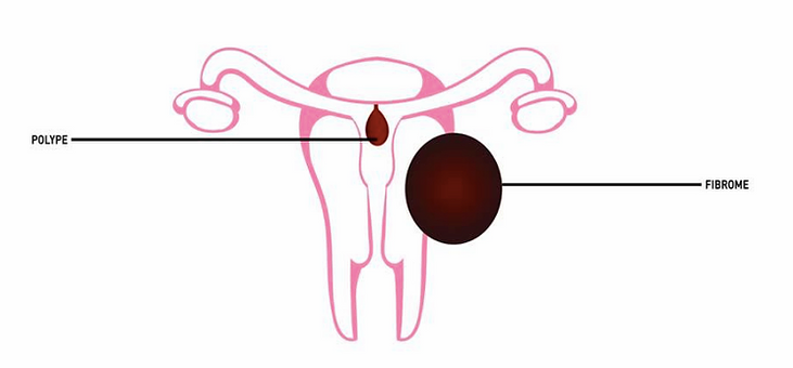 CHIRURGIE DE L'INFERTILITE