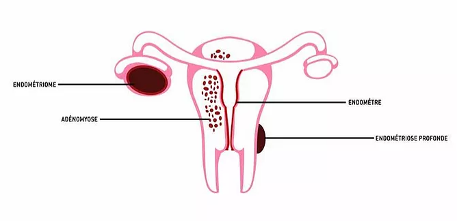 ENDOMETRIOSE DEFINITION / SYMPTOMES 2