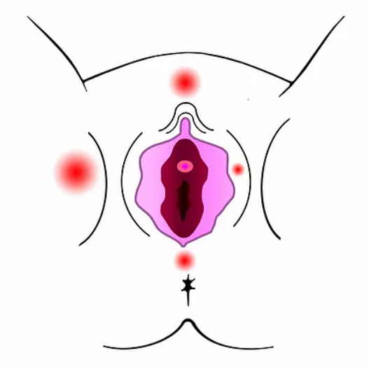 ENDOMETRIOSE DEFINITION / SYMPTOMES 1