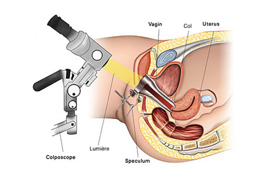 Colposcopie et conisation centre médical l'Avancée Aix-en-Provence