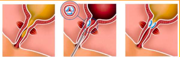 INCONTINENCE URINAIRE 1