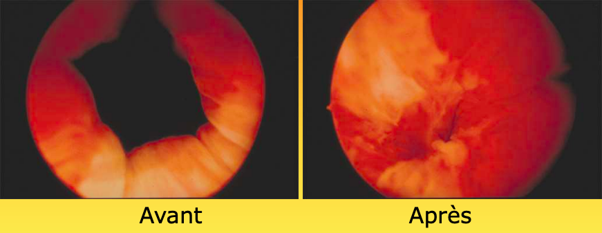 INCONTINENCE URINAIRE 2