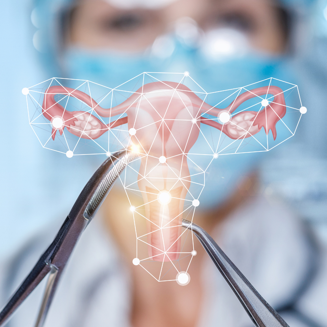 Chirurgie de l'utérus 1