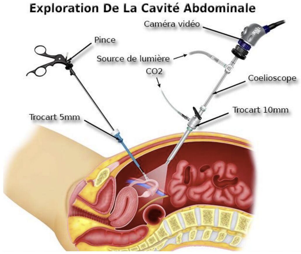 Coelioscopie abdominale