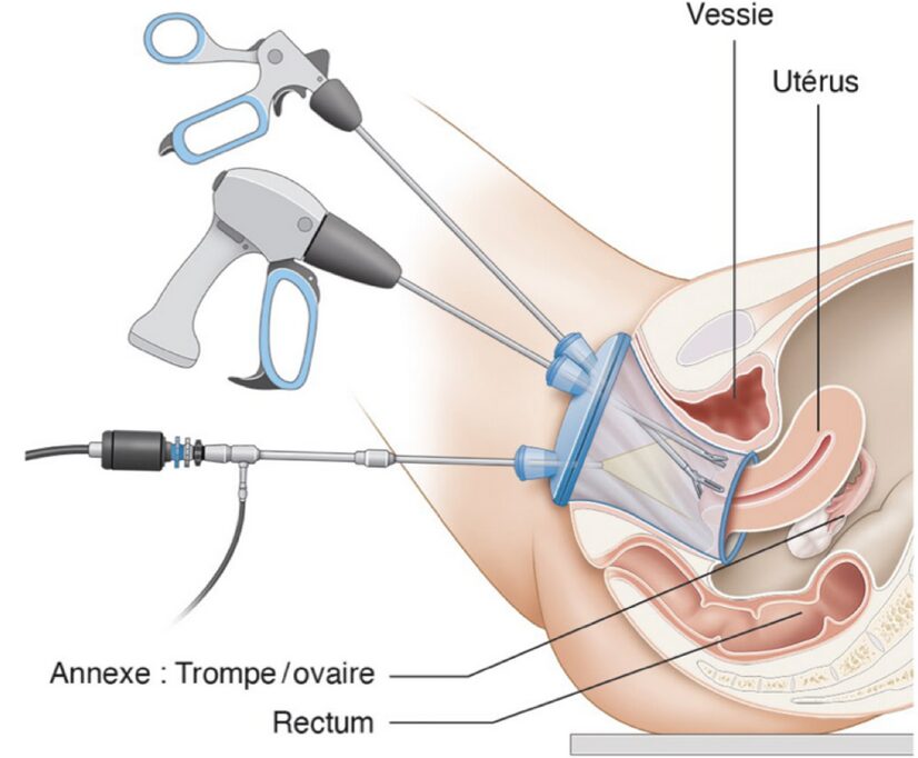 Coelioscopie vaginale vNotes